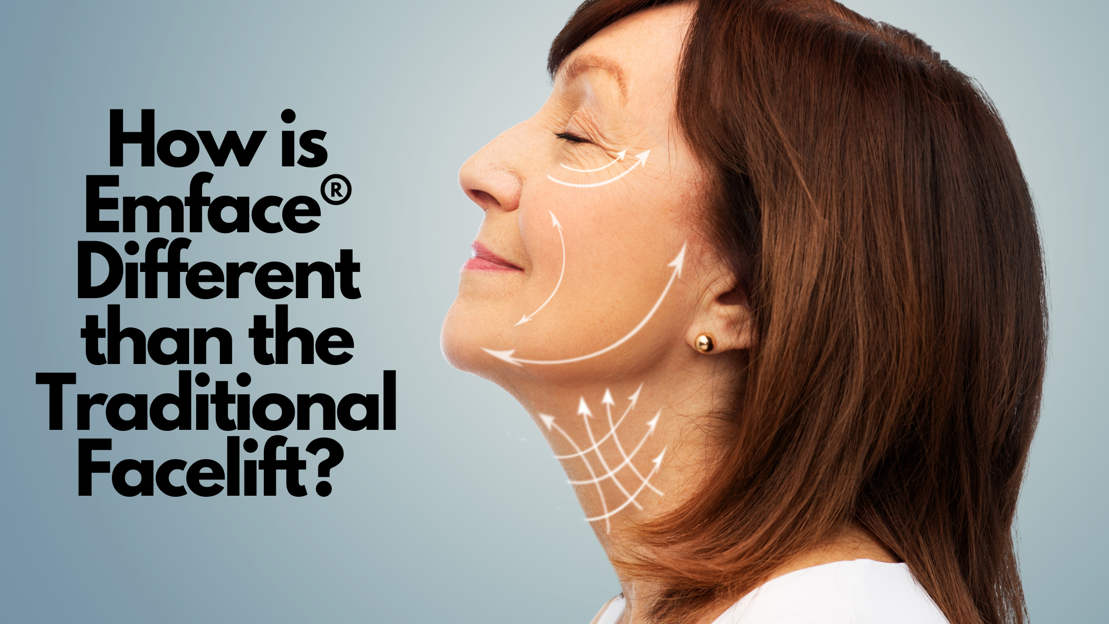 how is emface® different than the traditional facelift  kovak cosmetic center - how is emface® different than the traditional facelift