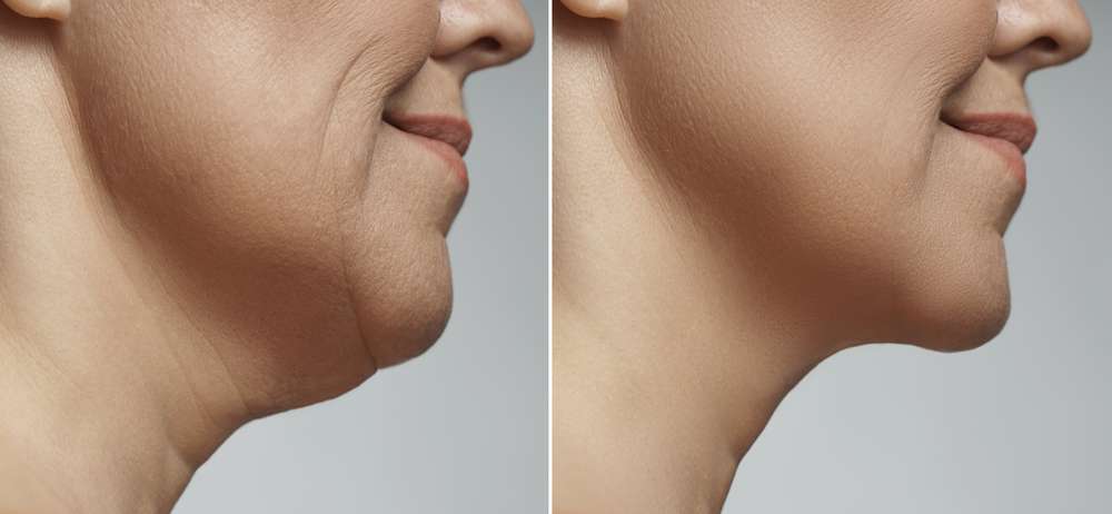 vaser liposuction with renuvion vlr jawline and body sculpting  kovak cosmetic center - vaser liposuction with renuvion vlr jawline and body sculpting