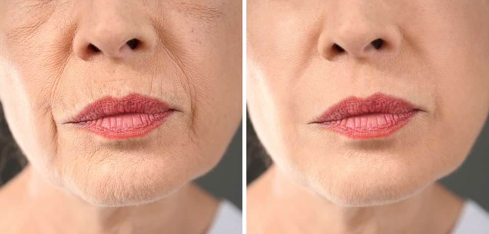 best treatment for lower face wrinkles  kovak cosmetic center - ellacor treatment services in chicago before and after