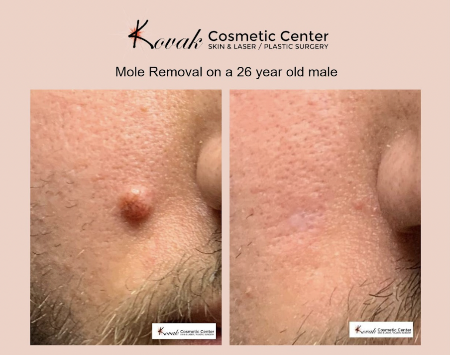 mole removal chicago