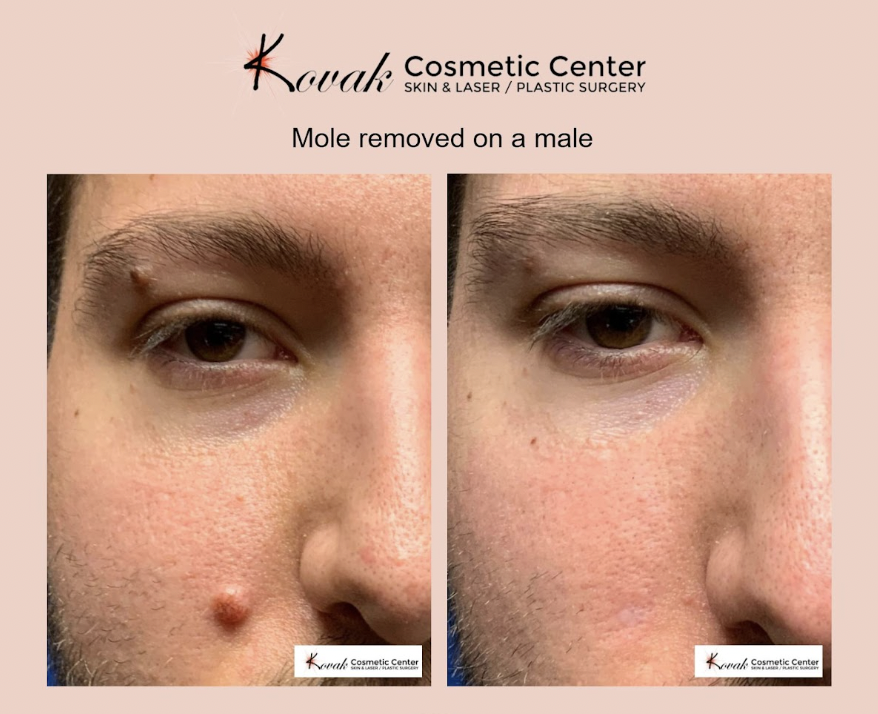 scarless laser mole removal vs. traditional surgical methods
