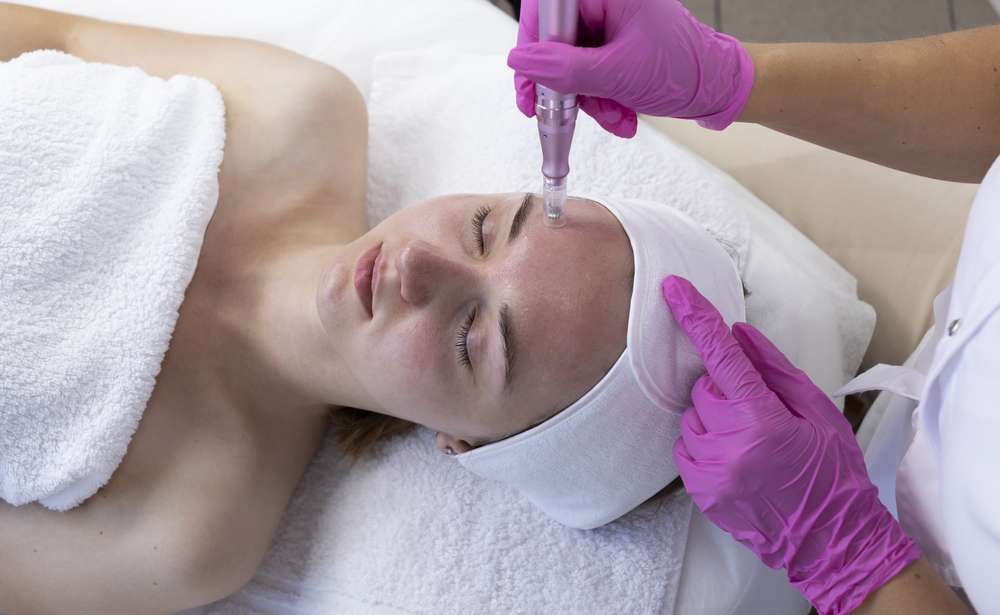 what is microneedling?