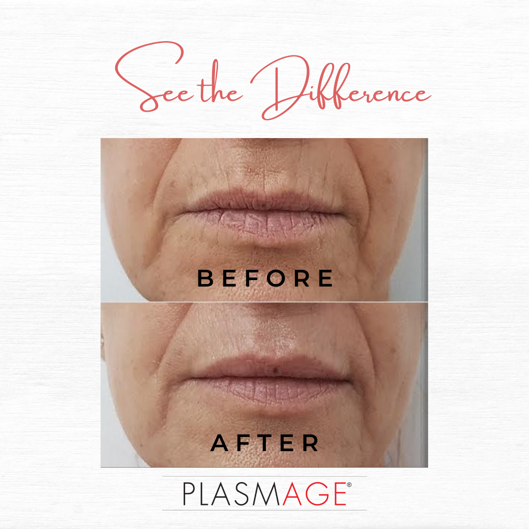 chicago plasmage treatment  kovak cosmetic center - chicago plasmage treatment before and after treatment photos