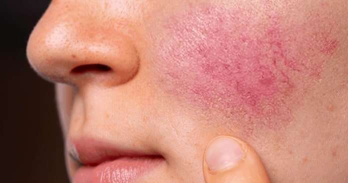 topical creams for rosacea in chicago  kovak cosmetic center - topical creams for rosacea in chicago